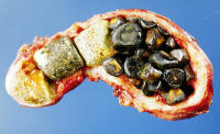 File:Gallstones.jpg